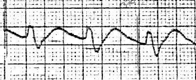 tcaecg3.jpg