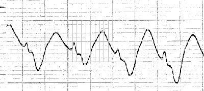 tcaecg4.jpg
